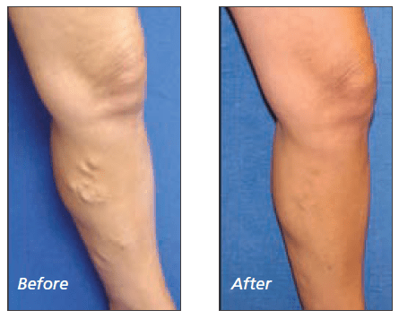 varicose veins