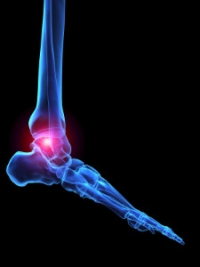 Signs of Rheumatoid Arthritis in the Feet