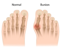 What Causes Bunions in Children?