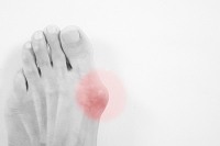 Are Bunions Considered To Be A Deformity?
