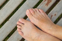 What Treatments Are Available for Hammertoes?