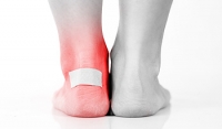 What Causes Foot Blisters?